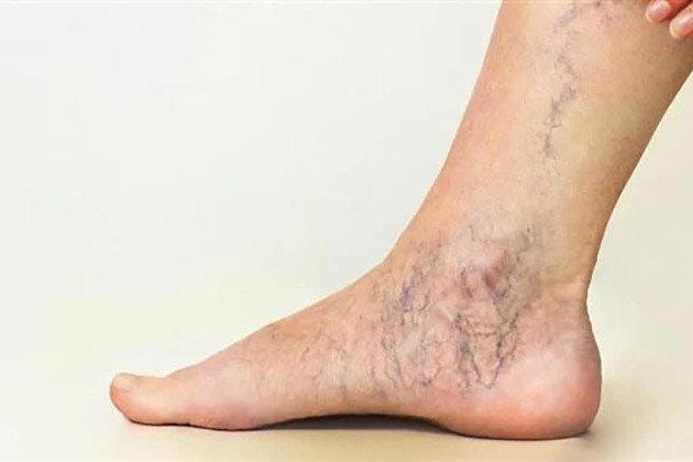 تعرف على طريقة علاج دوالي الساقين نهائيًا