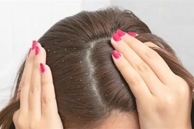 طريقة منزلية علاج قشرة الشعر نهائيا