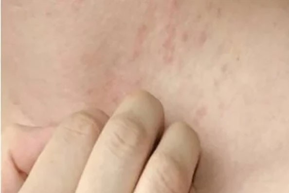 تعرف على أبرز سمات الحصبة والروبيلا الألمانية وطرق العلاج