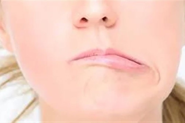 صعوبة في الابتسام أو إغلاق العين.. عدوى فيروسية نائمة تسبب شلل بيل