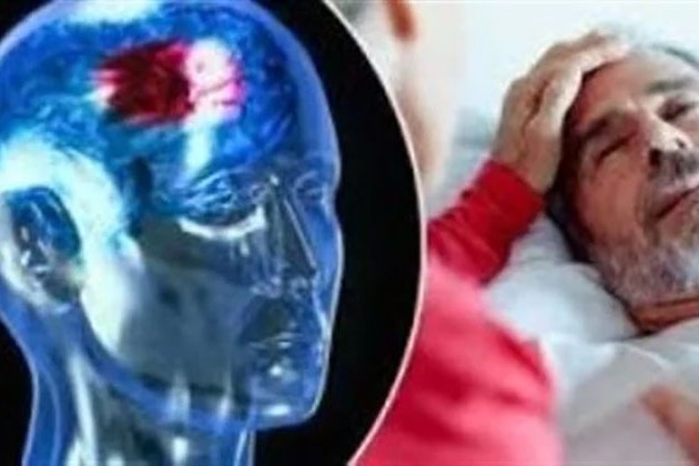 أعراض مبكرة تكشف إصابتك بالسكتة الدماغية