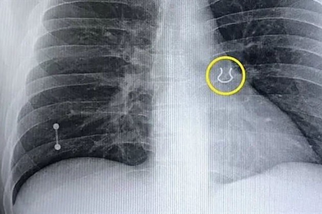بعد فقدانه 5 سنوات.. رجل يكتشف جسما غريبا في رئته