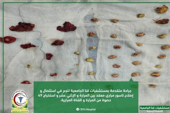 استخراج 49 حصوة من القناة المرارية لمريضة بمستشفيات قنا الجامعية